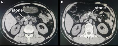 Electrohydraulic lithotripsy through endoscopic retrograde cholangiopancreatography combined with SpyGlass in the treatment of complex pancreatic duct stones: A case report and literature review